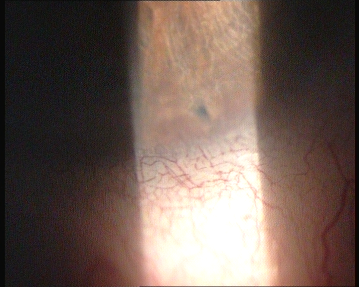 File:Inferior Iridotomy.png
