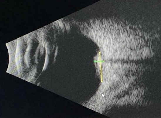 File:B scan retinocytoma.jpeg