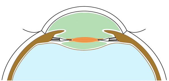 File:BIL fixation.png