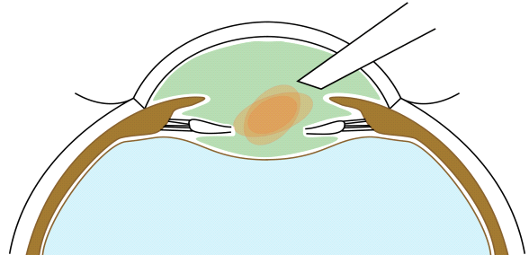 File:BIL injection.png