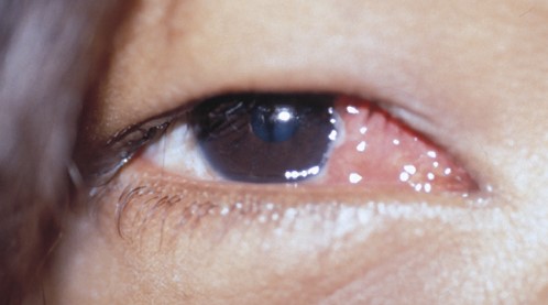 File:Conjunctival scarring.jpg