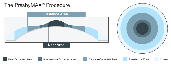 File:Presbymax diagram.jpg