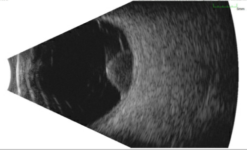 File:Choroidal melanoma bscan.png