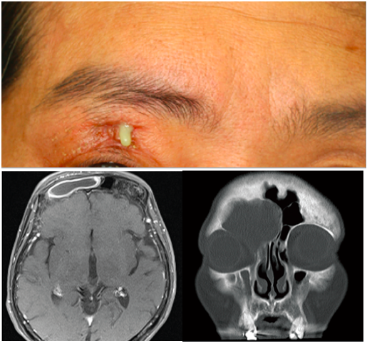 File:Figure2 fistula.png