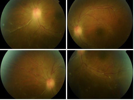 File:HTLV-1 uveitis case.jpeg
