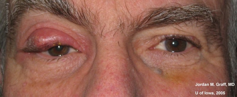 Chalazion Image from EyeRounds Online Atlas of Ophthalmology Contributor: Jordan M. Graff, MD, University of Iowa Category: External Disease Diagnosis: Chalazion