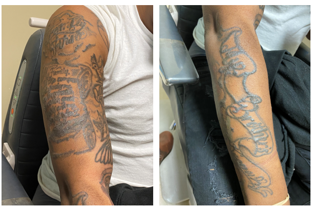 File:Tattoo induration in TAGU.png