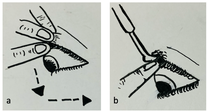 File:Globe luxation 7.png