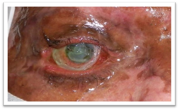 File:Amniotic Membrane Grafting.jpg