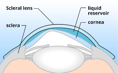 File:Scleral vault.jpg