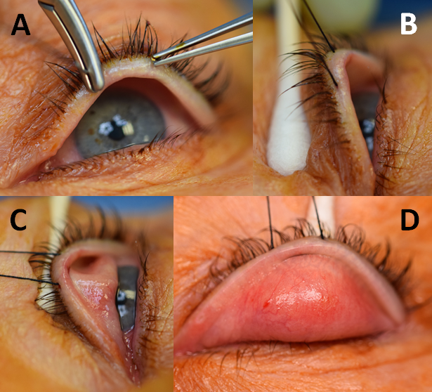 File:MMCR Eyewiki Figure 2.png