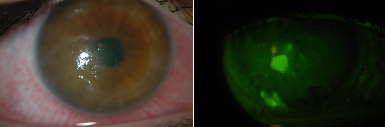 File:EK from neurotrophic keratopathy.jpg