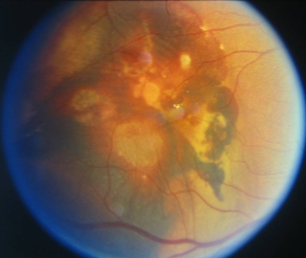 File:Polypoidal choroidopathy in african-american.jpg