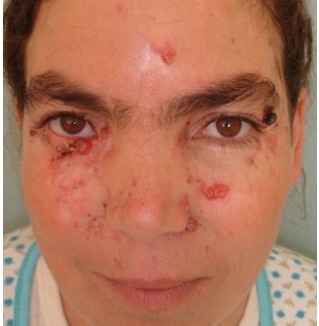 File:Gorlin-Goltz Syndrome.jpg