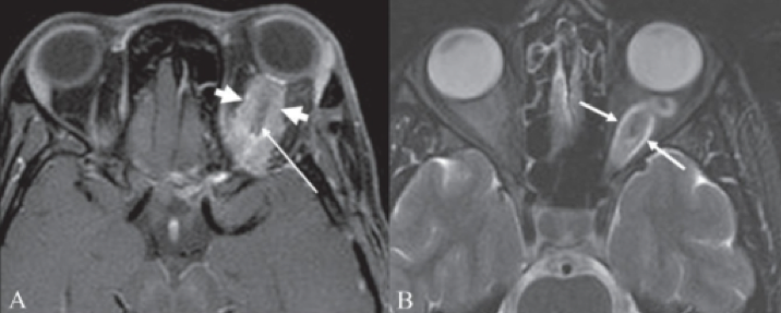 File:MRI GLIOMA NF1.png
