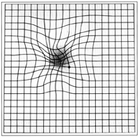 Hypothetical neovascular AMD change on an Amsler grid.