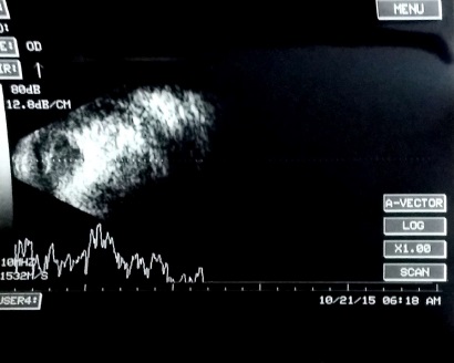 File:Echography retinoblastoma.jpg