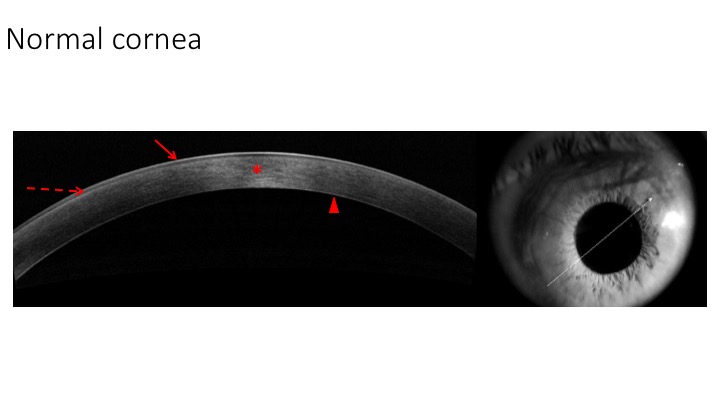 File:AS-OCT of normal cornea.jpeg