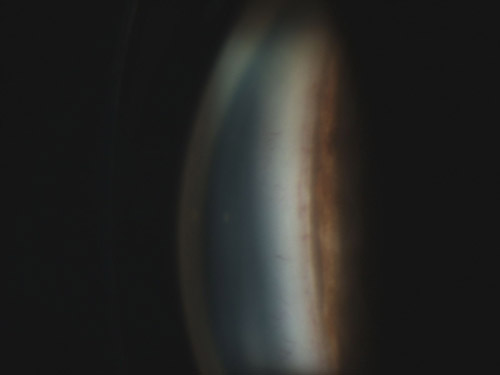 File:Gonioscopic view.jpg