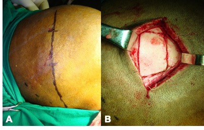 File:Orbital implant 3.jpg