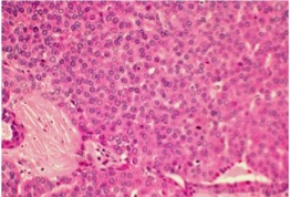 Fig. 4: Basaloid variant