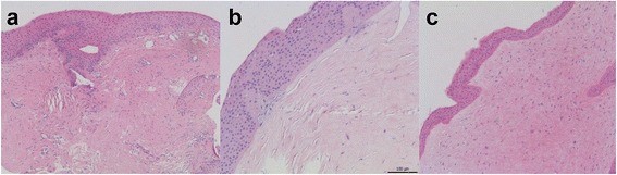 File:H&E corneal keloid.jpg