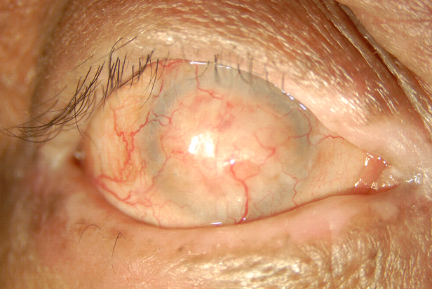 File:Complete keratinization of ocular surface in patient with OCP.png