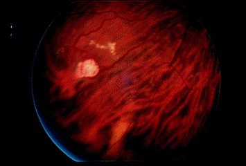 File:Ret capillary hemangioma.jpg