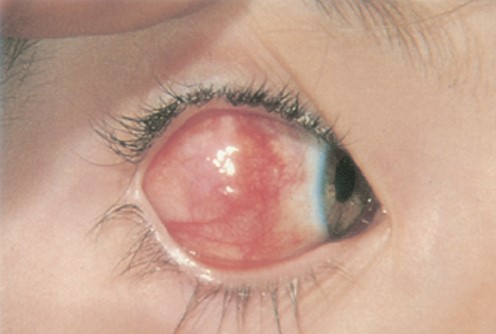 File:Allergic reaction.jpg