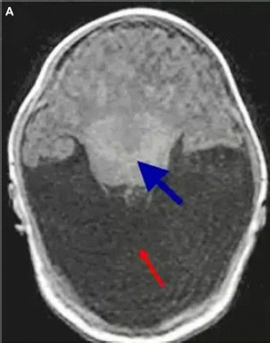 File:Cyclopia MRI.jpg