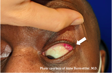 File:Palpebral lobe.png