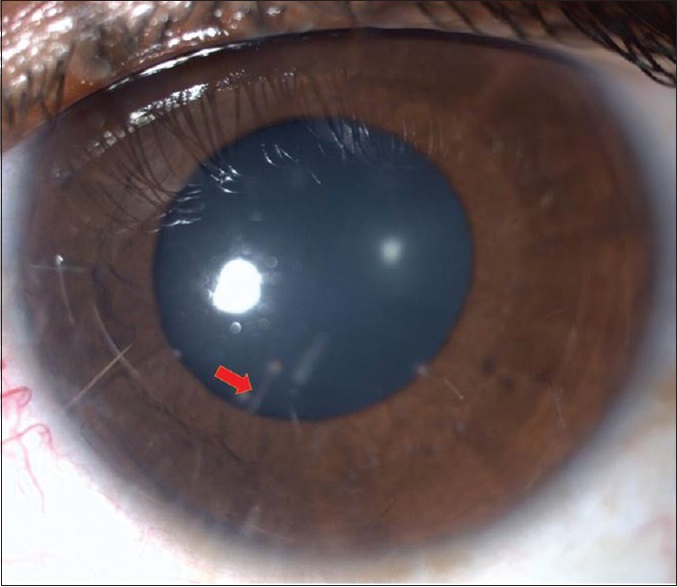 File:Corneal 2.jpeg