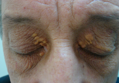 File:Xanthelasma.png