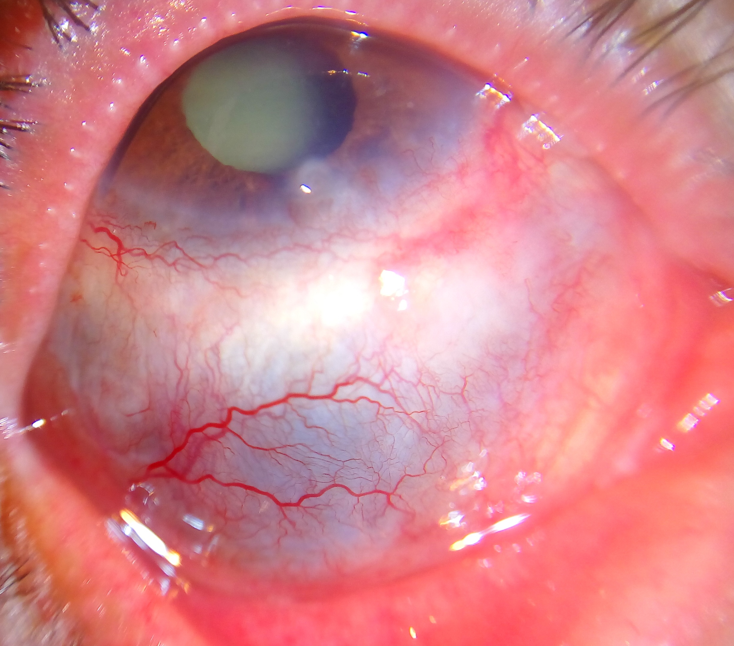 Scleritis