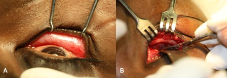 File:Orbital implant 2.jpg
