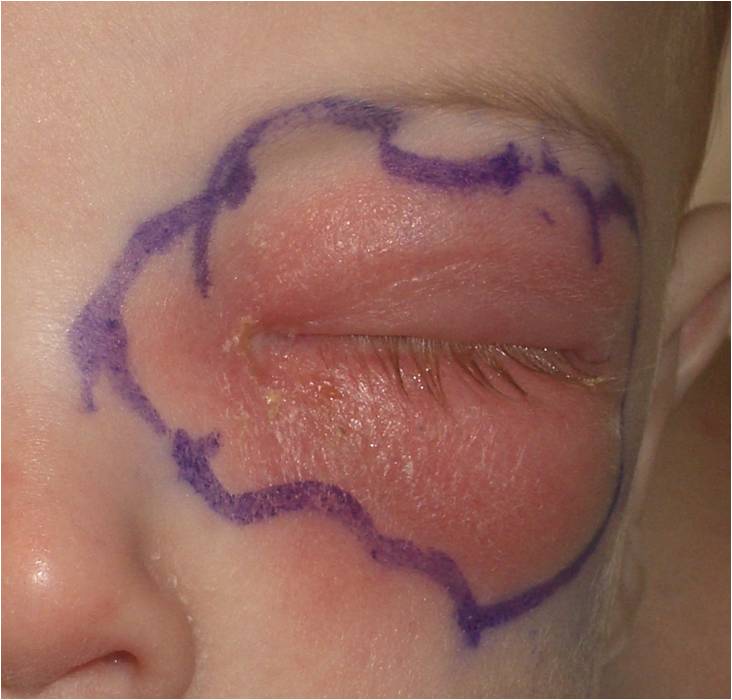8-month-old with recent upper respiratory infection and orbital cellulitis. Infection resolved with intravenous antibiotics.