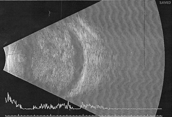 File:Medulloepithelioma Ultrasound.jpg