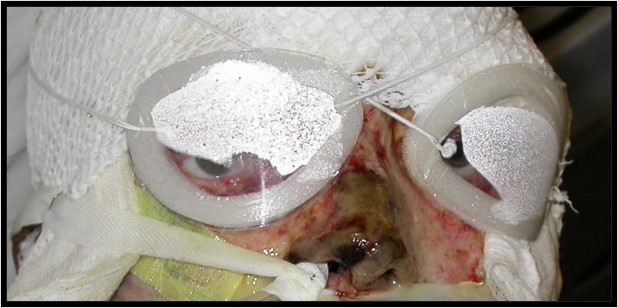 File:Moisture Chamber goggles.jpg