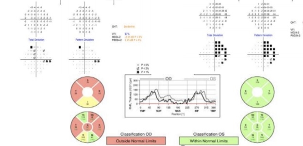 File:Humphrey visual field300.jpg