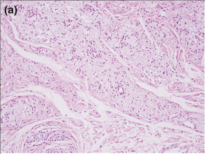 File:Xanthelasma path 2.png