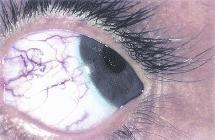 File:Ataxia telangiectasia.jpg