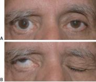 File:R facial nerve palsy.jpg