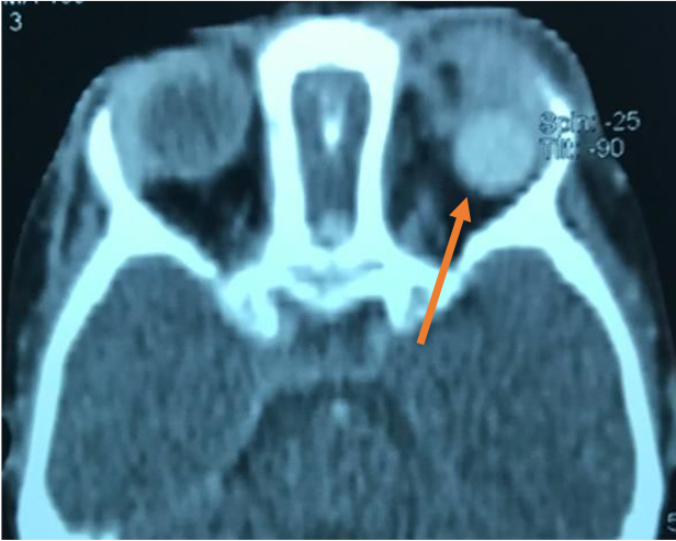 File:Post Enucleation migrated implant.png