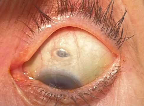 File:PDS Implanted.jpg