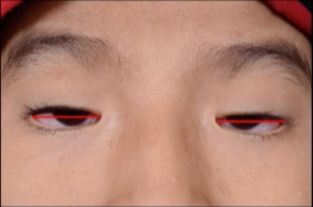 File:Horizontal shortening in blepharophimosis.png