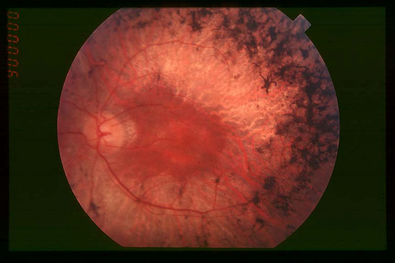 File:Retinitis pigmentosa.jpg