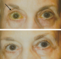 Fig 13: Patient on bimatoprost OU initially (top) and 1 month after discontinuation of medication (bottom). Note normalization of sulcus.