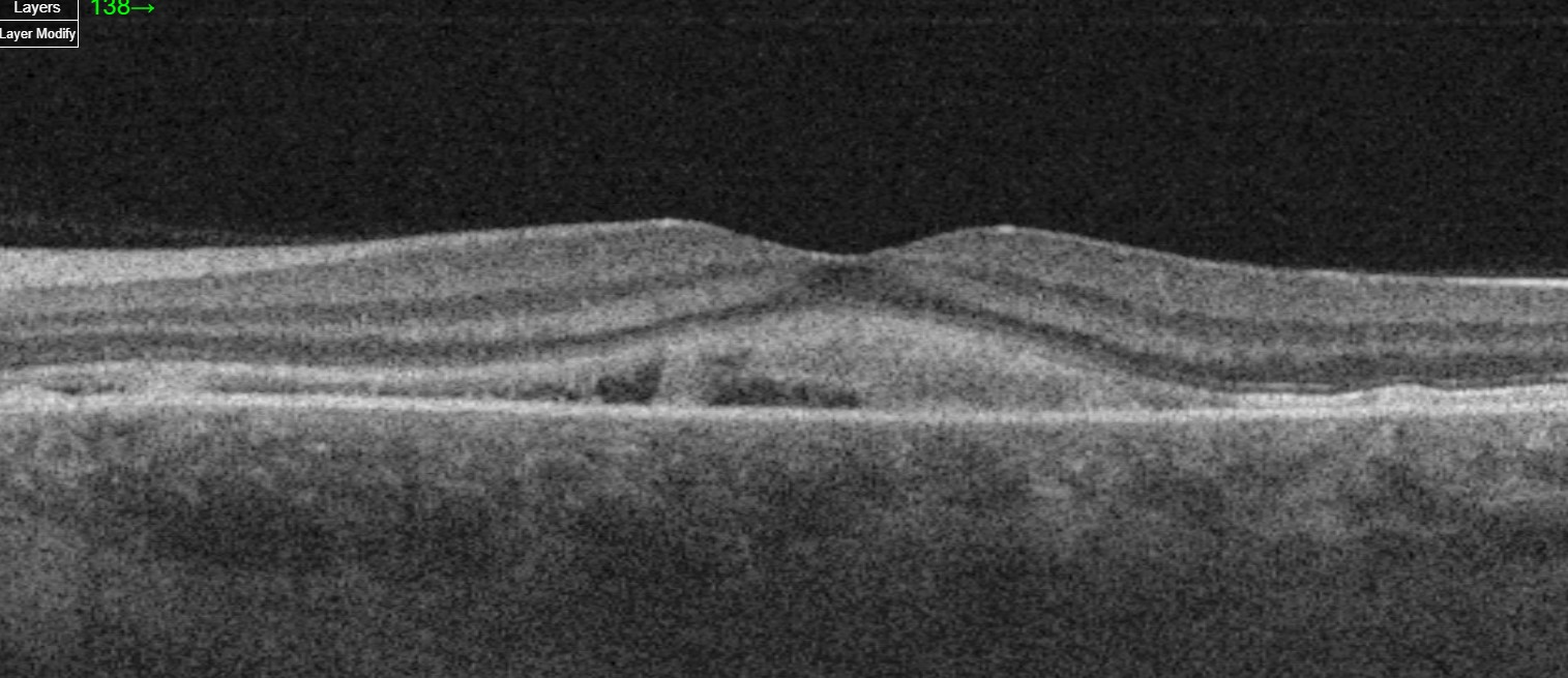 Bilateral serous retinal detachment with associated subretinal fibrin-like material in a case of pregnancy-induced hypertension.