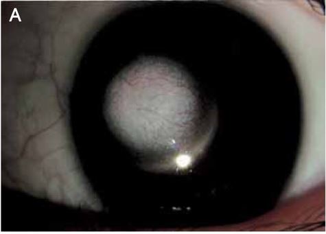File:Corneal keloid slit lamp.jpg