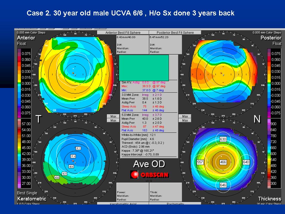Corneal Topography - EyeWiki
